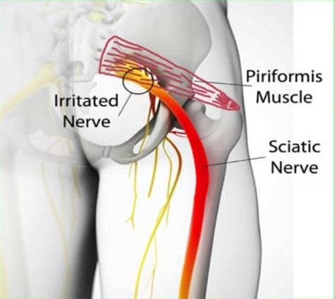 Piriformis Syndrome ⋆ Sports Massage Sb Santa Barbara Goleta Ca The Piriformis Muscle Can Also