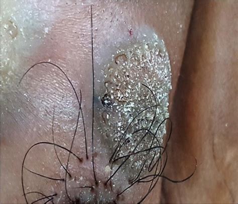 Recalcitrant plantar warts require aggressive cyrotherapy ftcs (which may be used as first line oni g and mahaffey p. Intralesional measles, mumps, and rubella vaccine for the ...