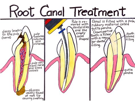 Root Canal Treatment Dental Fear Central
