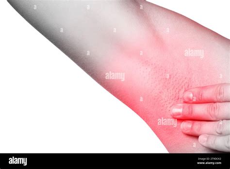 Closeup Of Female Armpit With Redness Skin Irritation Or Swollen Lymph