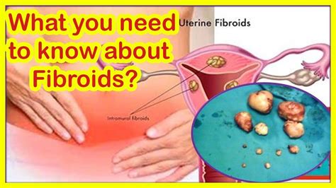 fibroids types causes and symptoms what you need to know about uterine fibroids youtube
