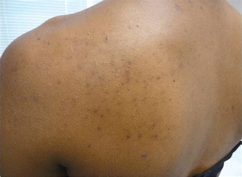 Best Ways Of Treating Back Acne Mdhairmixtress Dermatology Expert