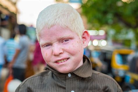 Does Albinism Affect Your Vision