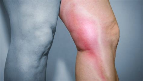 Trombose f (plural trombosen or tromboses). 10 coisas que você precisa saber sobre trombose - ViDA & Ação