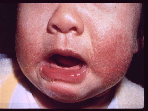 Baby Eczema Treatment Philadelphia Holistic Clinic Dr Tsan And Assoc