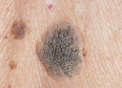 Le nævus mélanocytaire, plus communément appelé point ou grain de beauté, est une petite tache de forme généralement circulaire ou ovale, située sur le dessus de la peau. Dermatologie - Tout savoir sur les problèmes de peau ...