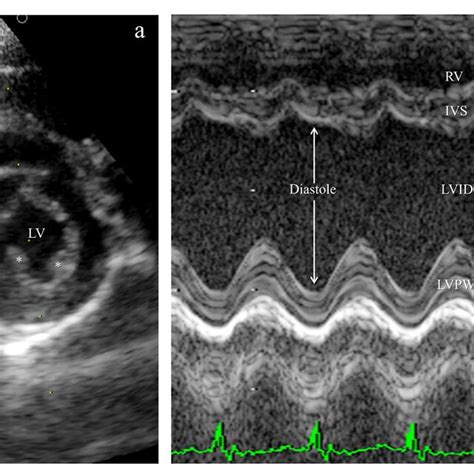 A Parasternal Short Axis View At Papillary Muscle Level B