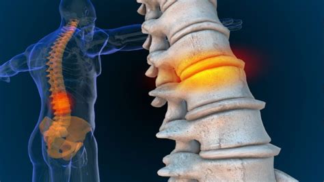 Arthritis Of The Spine In Plano And Frisco Tx American Neurospine Institute Pllc