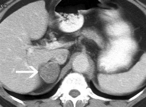 Ct And Mr Imaging Of The Adrenal Glands In Acth Independent Cushing