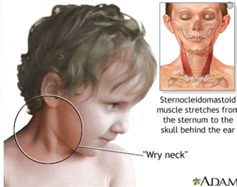 Congenital Muscular Torticollis Medizzy