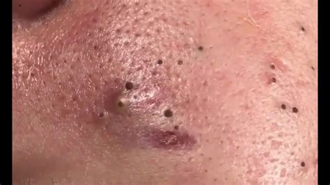 How To Remove Blackhead And How To Get Rid Blackhead 4 Youtube