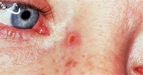 Skin Cancer Images Nose Idaman
