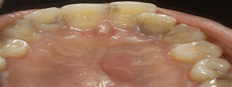 Pre Operative Palatal View With Swelling Seen In Rugae Area Download