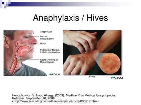 Anaphylaxis Rash Anaphylaxis An Overview Health And Medical