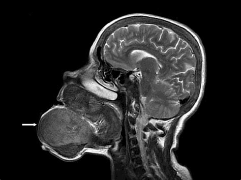 Sagittal Magnetic Resonance Imaging Scan Showed That The Brown Tumor