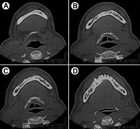 Anterior Mandibular Swelling Journal Of Oral And Maxillofacial Surgery