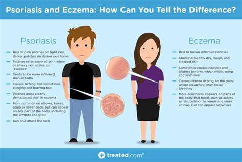 Psoriasis And Eczema How Can You Tell The Difference