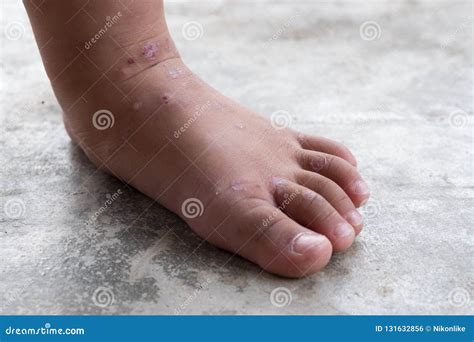 Itchy Dermatitis Atopic Baby Foot Stock Photo Image Of Care Flesh