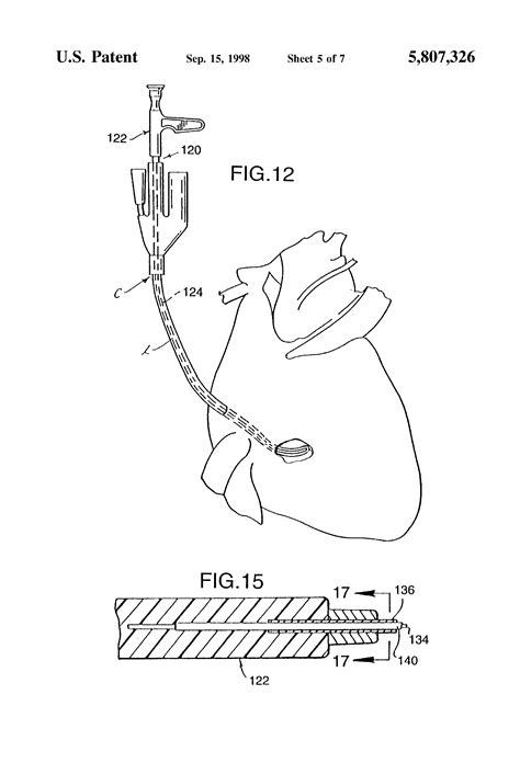 Definitions for coronary sinus coro·nary si·nus. Patent US5807326 - Retrograde coronary sinus catheter ...