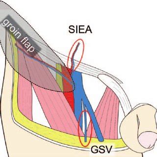 Flow diagram of numerical model the effect of the wood piles on incoming waves is simulated by a shoal with the same geometric dimensions as the figure 9: (PDF) Vein/Arterial Grafts Harvested within the Incision for a Free Groin Flap