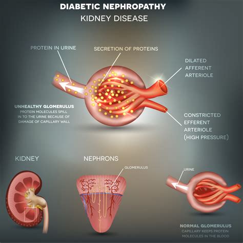 Diabetes and kidney friendly recipes. Diabetic Nephropathy - myDario.co.uk