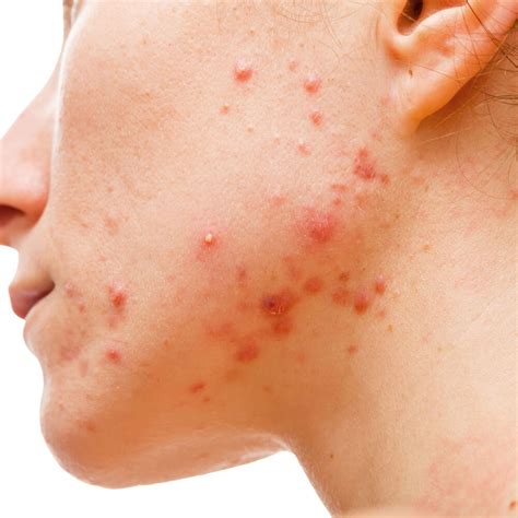 Acne Scars — Virginia Square Dermatology Isabela Jones Md