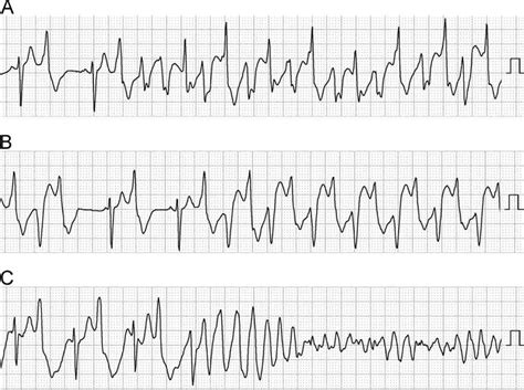 Ventricular Tachycardia Causes Symptoms Diagnosis Prognosis Treatment