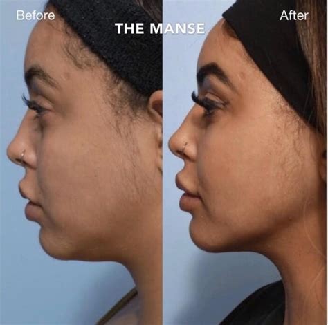 Double Chin Injections In Sydney The Manse Clinic