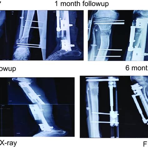 Pdf Management Of Compound Fractures Of Tibia By Limb Reconstruction