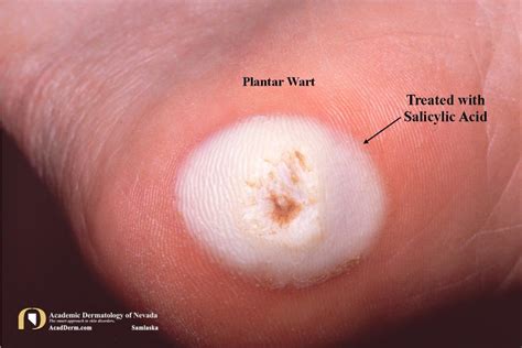 Plantar Warts Verruca Plantaris Seed Warts Academic Dermatology