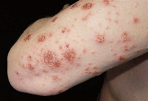 Severe Generalized Nummular Eczema Secondary To Interferon Alfa 2b