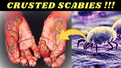 scabies causes signs and symptoms diagnosis and treatment youtube