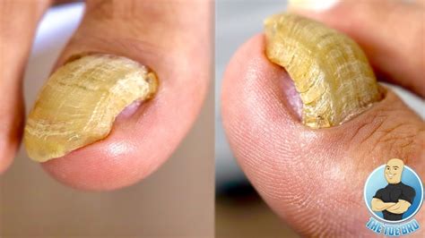 Ripping Out And Removing A Damaged Thickened Toenail Youtube