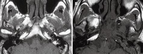Magnetic Resonance Imaging Staging Of Nasopharyngeal Carcinoma In The