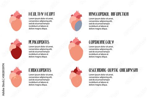 Heart Cardiovascular Diseases Pericarditis Endocarditis Myocardial