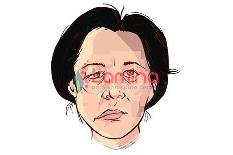 Beberapa asimetrik komplikasi adour membagi komplikasi bell's palsy menjadi komplikasi dini dan komplikasi lanjut. Bell's Palsy Penyebab Kelumpuhan Otot Wajah » Klinik Arfa
