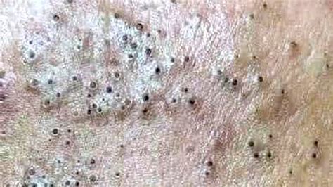 Big Cystic Acne Blackheads Extraction Blackheads And Milia Whiteheads