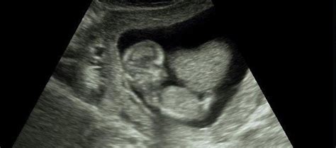 Free Ultrasounds Confirm Your Pregnancy Catherine Foundation