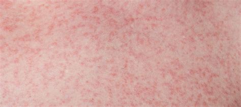 Dengue is most dangerous of all. Dengue rashes: Appearance, Symptoms and Meaning | General ...