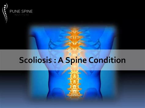 Ppt Scoliosis A Spine Condition Powerpoint Presentation Free