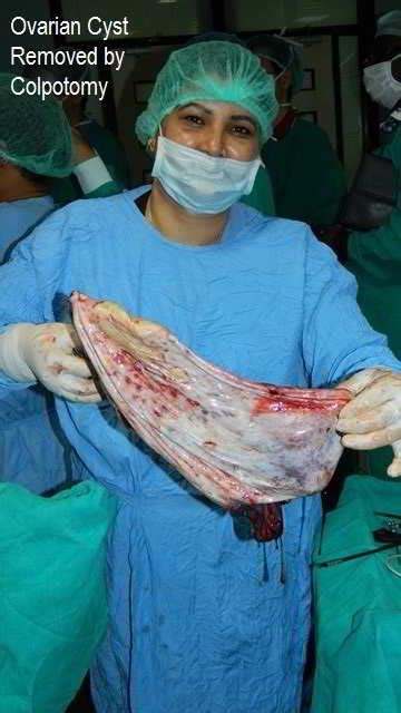 Laparoscopic Ovarian Cystectomy For Huge Ovary