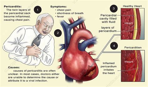 Heart Inflammation Pericarditis Symptoms Pericarditis Signs And