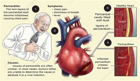 • pericarditis • pain • friction rub • rarely causes hemodynamic instability/tamponade or. Pericarditis, Illustration - Stock Image - C030/5917 ...
