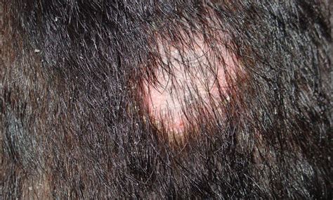 Alopecia areata (patchy baldness) is a noncontagious, autoimmune disease in which white blood cells release chemical messengers known as cytokines to attack healthy cells located in hair follicles. Unresponsive Alopecia in an Older Dog | Clinician's Brief ...