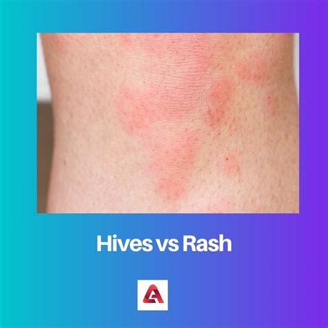 Difference Between Hives And Rash