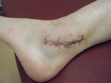 Braceability.com has been visited by 10k+ users in the past month Subluxing Peroneal Tendons: November 2012