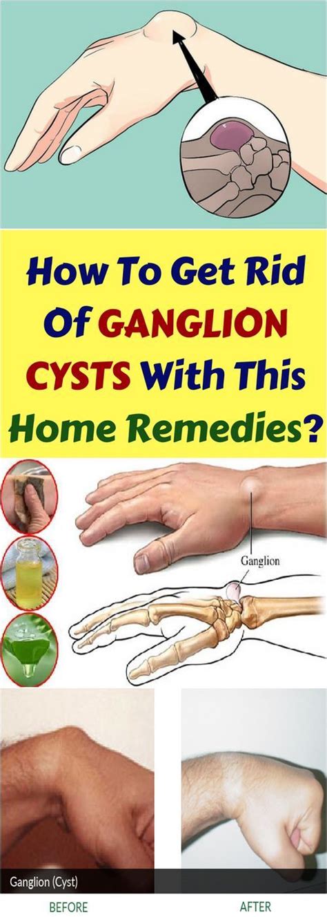 Let Start Slim Today How To Get Rid Of Ganglion Cysts And This Home