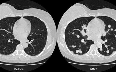 Using a ct scan for guidance if the tests described above show that you have lung cancer, you will have further tests to see whether the cancer has. Israeli researchers show medical scans vulnerable to fake ...