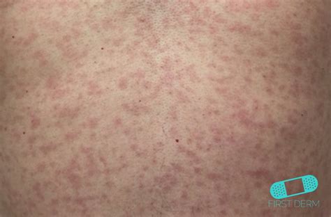 The man's zika infection started with a headache. Online Dermatology - Zika Virus (Rash)