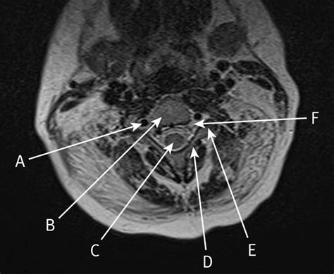 Axial T Weighted Magnetic Resonance Image Of The Cervical Spine The Bmj